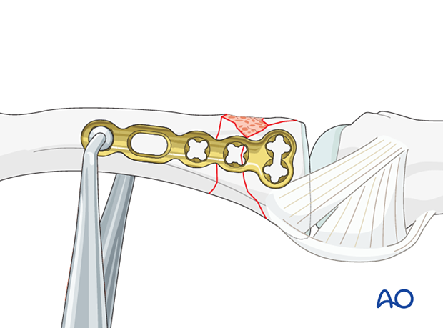 Plate fixation of a complete articular fracture of the proximal phalangeal base – holding the plate to the bone