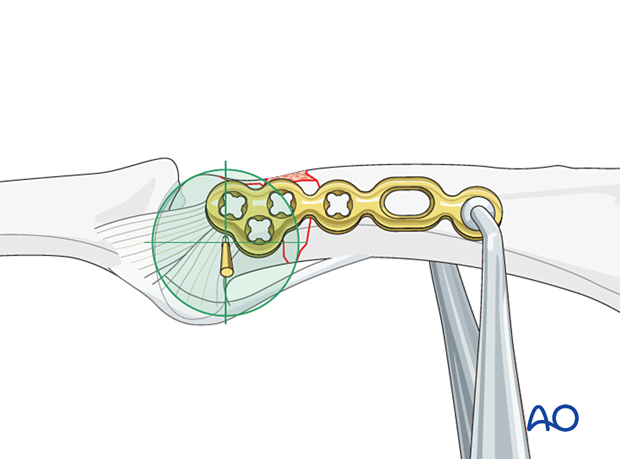 Plate fixation of a complete articular fracture of the proximal phalangeal head – holding the plate in position