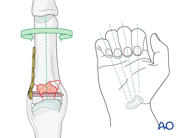 Plate fixation of a complete articular fracture of the proximal phalangeal base – correcting malrotation