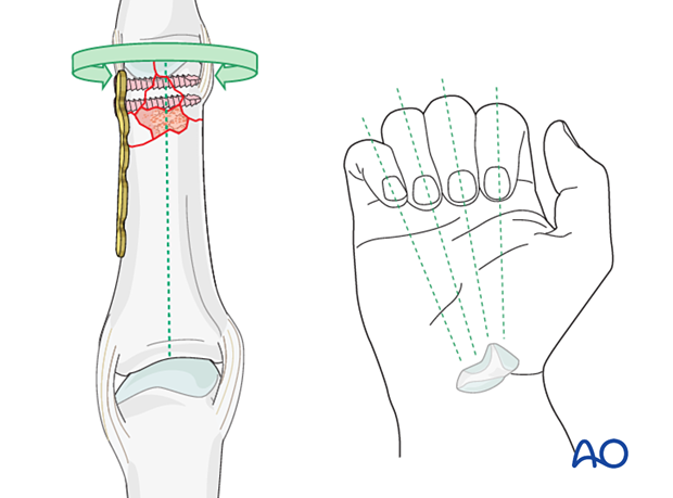 Plate fixation of a complete articular fracture of the proximal phalangeal head – correcting malrotation