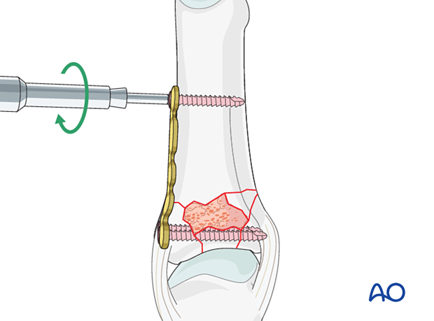 Plate fixation of a complete articular fracture of the proximal phalangeal base – insertion of a screw in the diaphysis