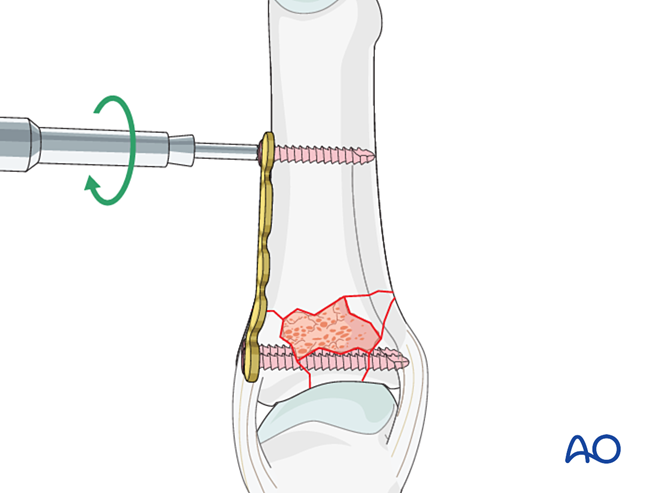 Plating with a lateral plate for Complete articular fracture of the ...