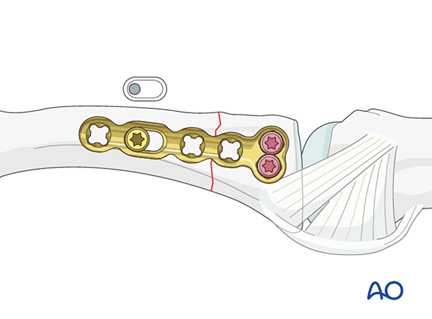 Compression plating of a complete articular fracture of the proximal phalangeal base