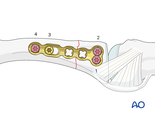 Compression plating of a complete articular fracture of the proximal phalangeal base – order of screw insertion