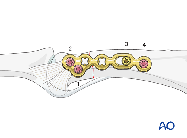 Compression plating of a complete articular fracture of the proximal phalangeal head – order of screw insertion