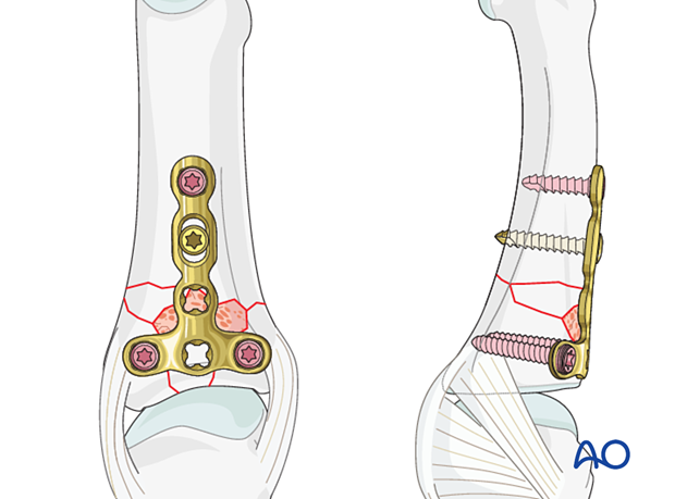 Dorsal plating of a complete articular fracture of the proximal phalangeal base