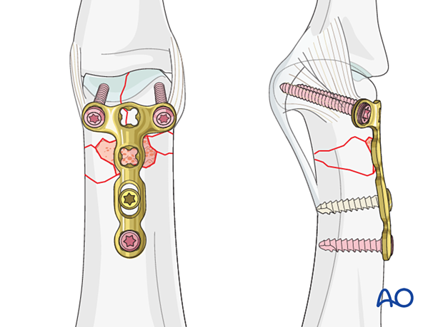 Dorsal plating of a complete articular fracture of the proximal phalangeal head