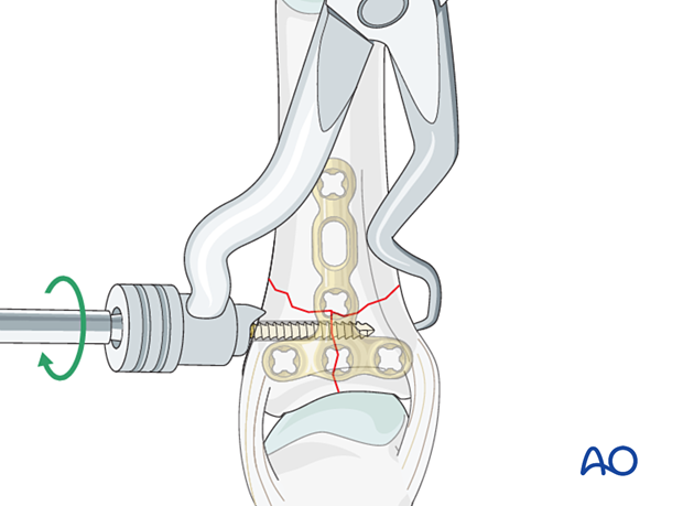 Screw fixation of a T-type articular fracture of the proximal phalangeal base