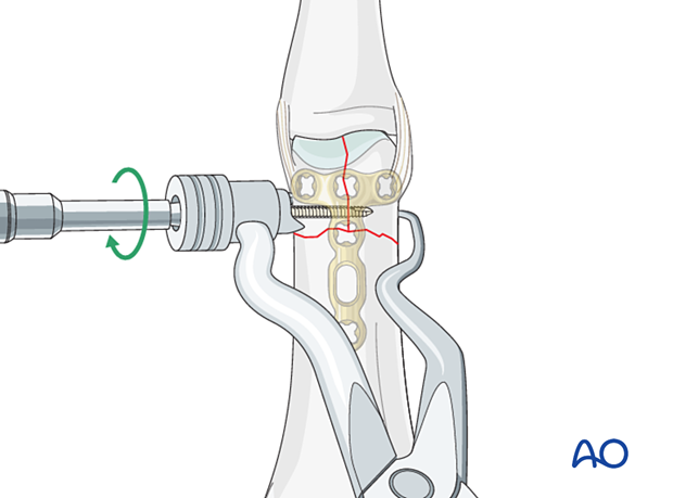 Screw fixation of a T-type articular fracture of the proximal phalangeal head