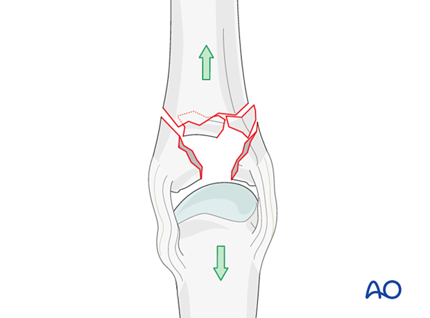 Reduction of a complete articular fracture of the proximal phalangeal base by traction