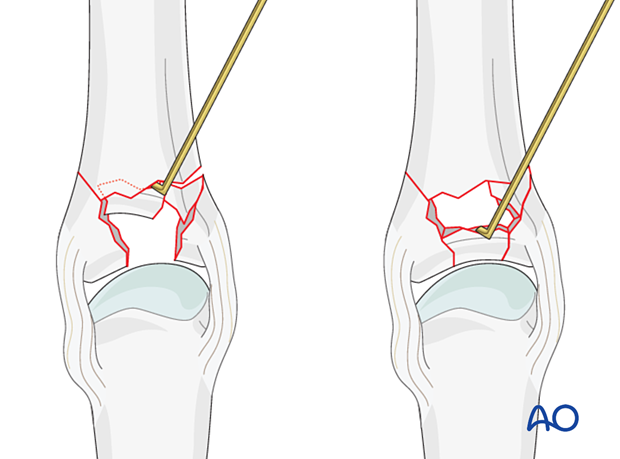 Reduction of a complete articular fracture of the proximal phalangeal base with a dental pick