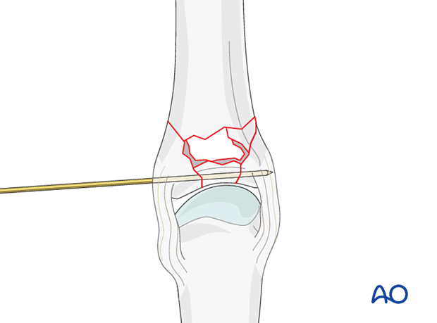 Holding the reduction of a complete articular fracture of the proximal phalangeal base with a K-wire