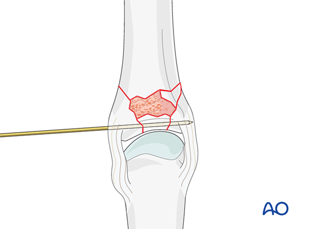 Reduced complete articular fracture of the proximal phalangeal base with a K-wire and bone graft