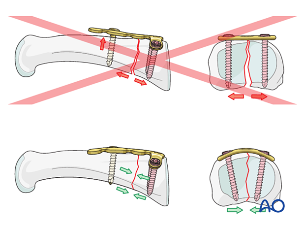 Dorsal plating of a complete articular T-type fracture of the proximal phalangeal base – Plate contouring