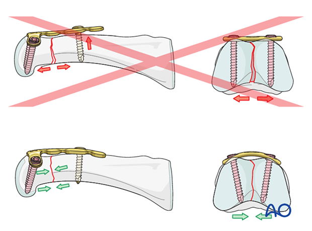 Dorsal plating of a complete articular T-type fracture of the proximal phalangeal head – Plate contouring