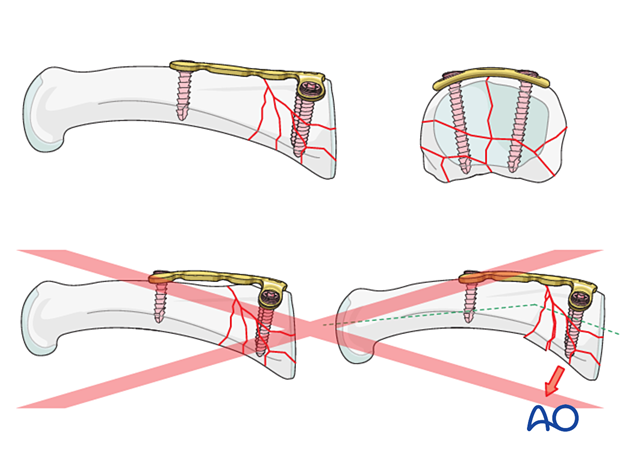 Dorsal plating of a multifragmentary articular fracture of the proximal phalangeal base – Plate contouring