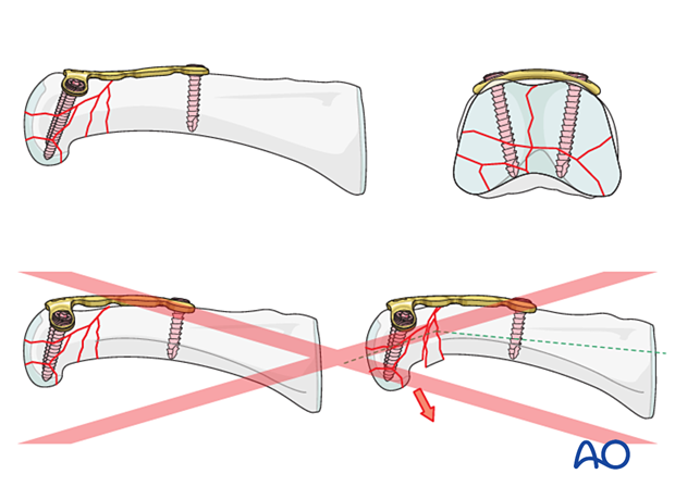 Dorsal plating of a multifragmentary articular fracture of the proximal phalangeal head – Plate contouring