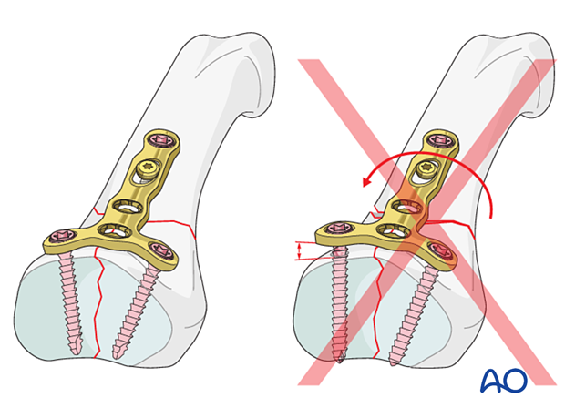 Dorsal plating of a complete articular fracture of the proximal phalangeal base – Plate contouring