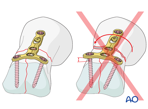 Dorsal plating of a complete articular fracture of the proximal phalangeal head – Plate contouring