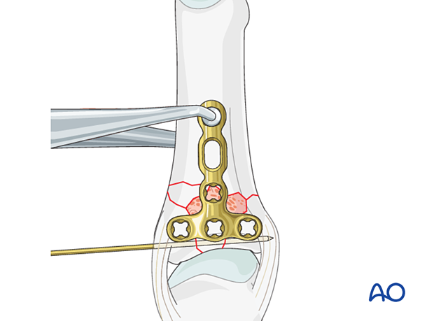 Dorsal plating of a complete articular fracture of the proximal phalangeal base – Plate positioning