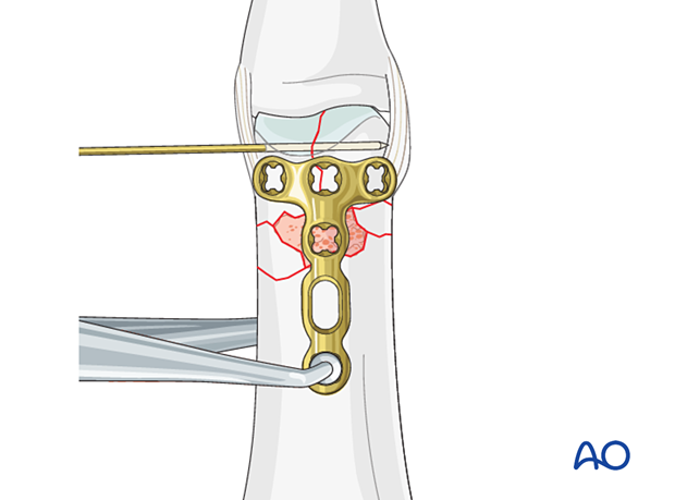 Dorsal plating of a complete articular fracture of the proximal phalangeal head – Plate positioning