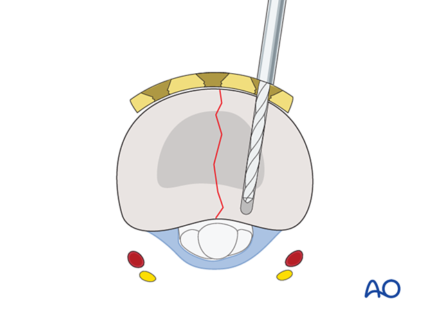 Dorsal plating of a complete articular fracture of the proximal phalangeal base – drilling