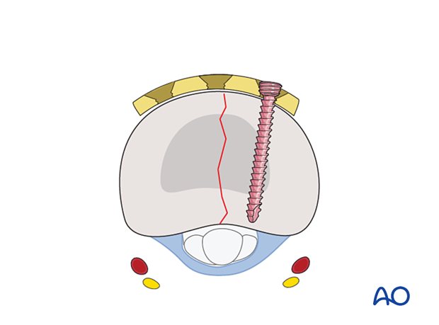 Dorsal plating of a complete articular fracture of the proximal phalangeal base – Insertion of first screw