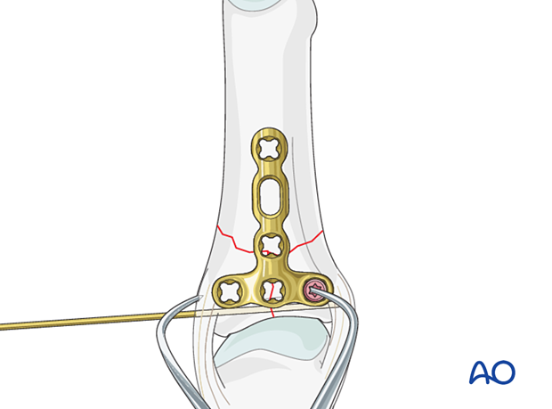 Dorsal plating of a complete articular fracture of the proximal phalangeal base – Extrinsic compression of the articular fracture