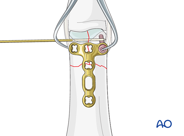 Dorsal plating of a complete articular fracture of the proximal phalangeal head – Extrinsic compression of the articular fracture