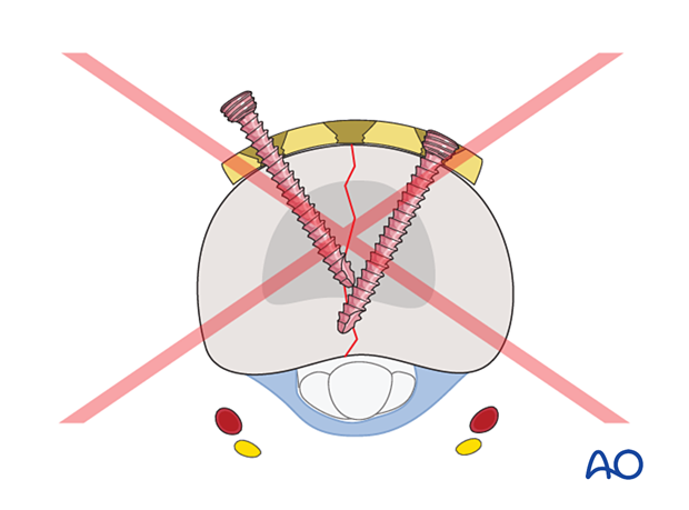 Dorsal plating of a complete articular fracture of the proximal phalangeal base – Conflicting screw tips