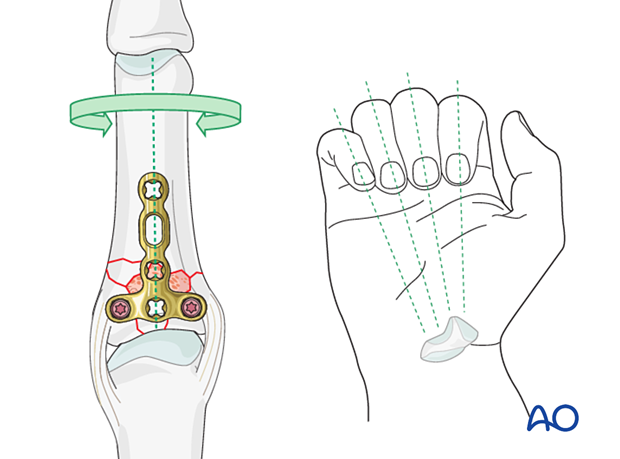 Dorsal plating of a complete articular fracture of the proximal phalangeal base – correcting length and rotation