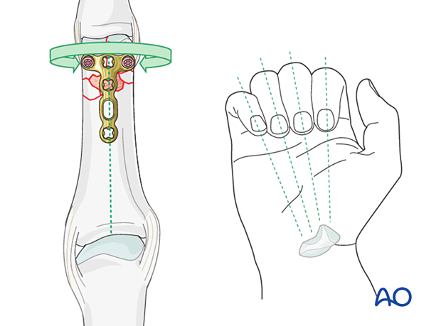 Dorsal plating of a complete articular fracture of the proximal phalangeal head – correcting length and rotation