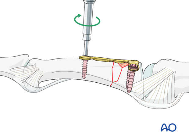 Dorsal plating of a complete articular fracture of the proximal phalangeal base – screw insertion