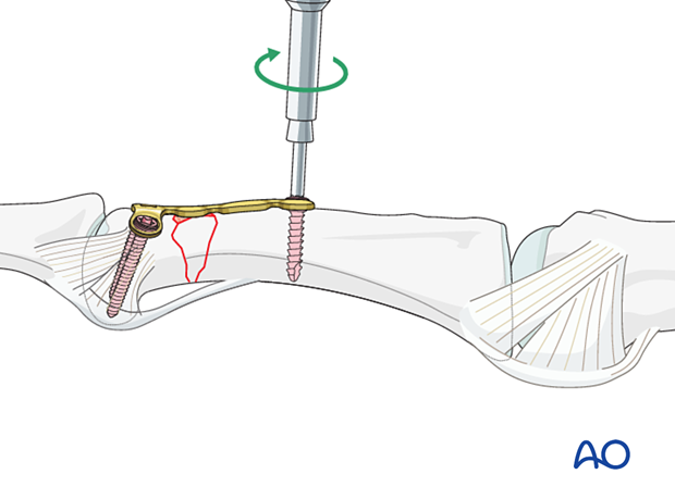 Dorsal plating of a complete articular fracture of the proximal phalangeal head – screw insertion