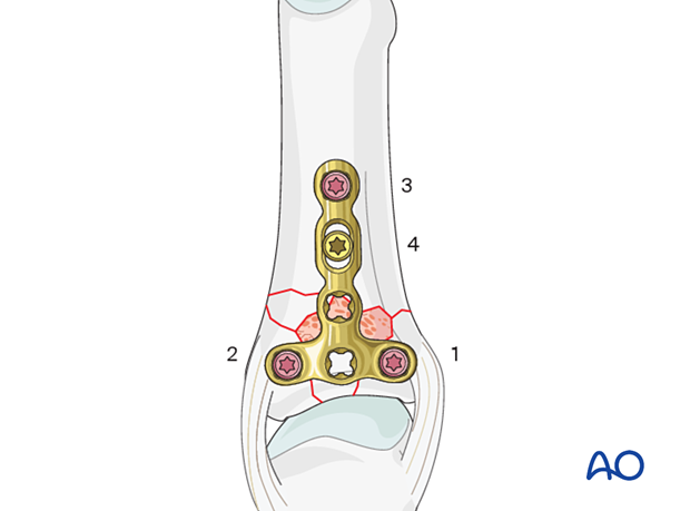 Dorsal plating of a complete articular fracture of the proximal phalangeal base – Order of screw insertion