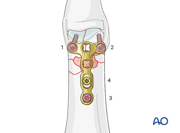 Dorsal plating of a complete articular fracture of the proximal phalangeal head – Order of screw insertion