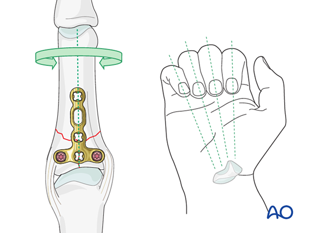 Dorsal plating of a complete articular fracture of the proximal phalangeal base – correcting length and rotation