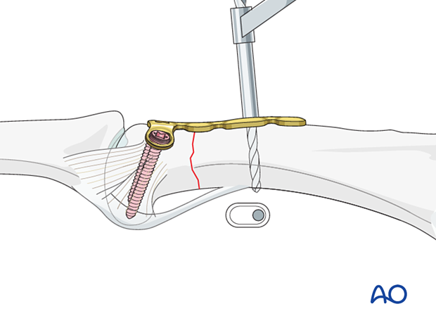 Dorsal plating of a complete articular fracture of the proximal phalangeal head – Drilling for compression screw