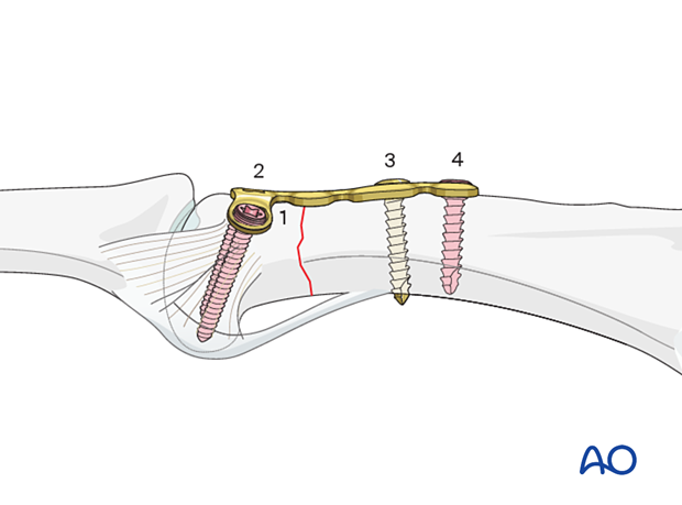 Dorsal plating of a complete articular fracture of the proximal phalangeal head – Order of screw insertion