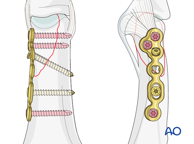 Lag-screw fixation with a neutralization plate of a partial articular fracture of the proximal phalangeal head