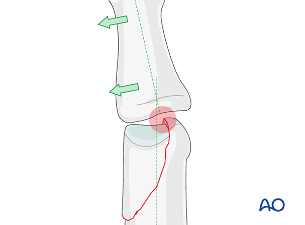 Displacement forces in a partial articular fracture of the proximal phalangeal head