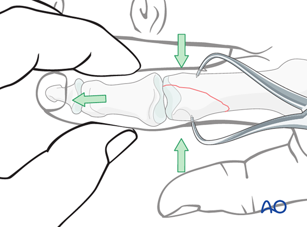 Indirect reduction of a partial articular fracture of the proximal phalangeal head