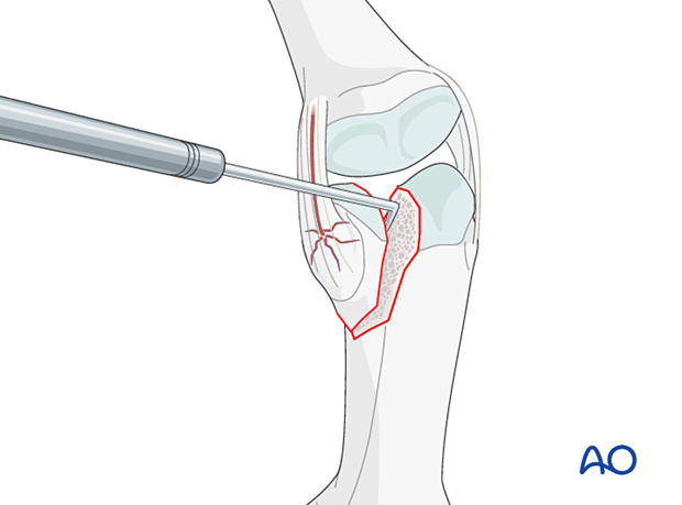 Visualization of a partial articular fracture of the proximal phalangeal head with a dental pick