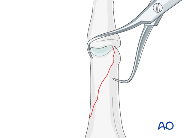 Holding the reduction of a partial articular fracture of the proximal phalangeal head with forceps