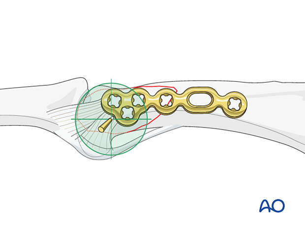 Preliminary K-wire fixation of a partial articular fracture of the proximal phalangeal head and plate positioning