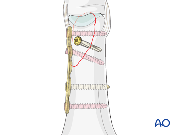 Lag screw outside of a neutralization for fixation of a partial articular fracture of the proximal phalangeal head