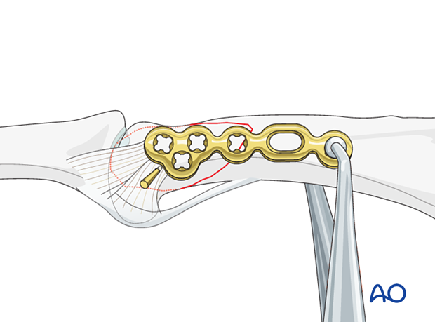 Lag-screw fixation with a neutralization plate of a partial articular fracture of the proximal phalangeal head – plate application