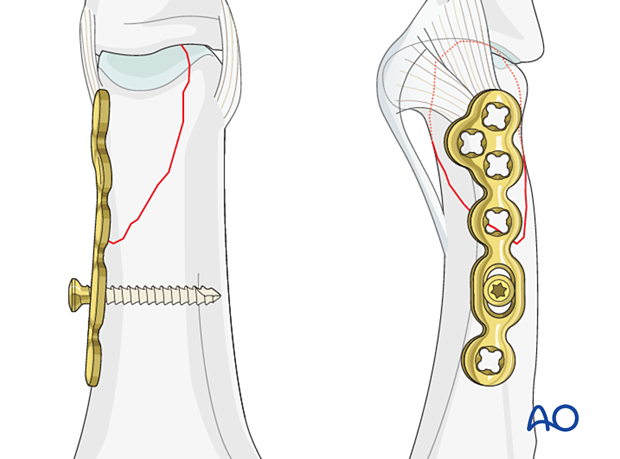 Lag-screw fixation with a neutralization plate of a partial articular fracture of the proximal phalangeal head – Insertion of first screw