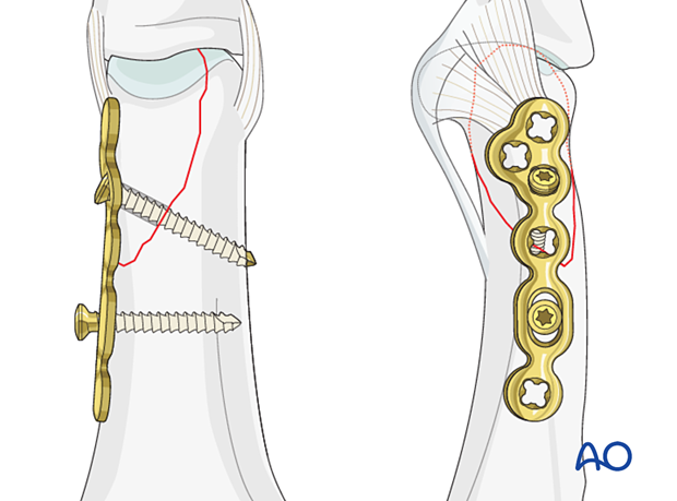 Lag-screw fixation with a neutralization plate of a partial articular fracture of the proximal phalangeal head – insertion of a lag screw through the plate