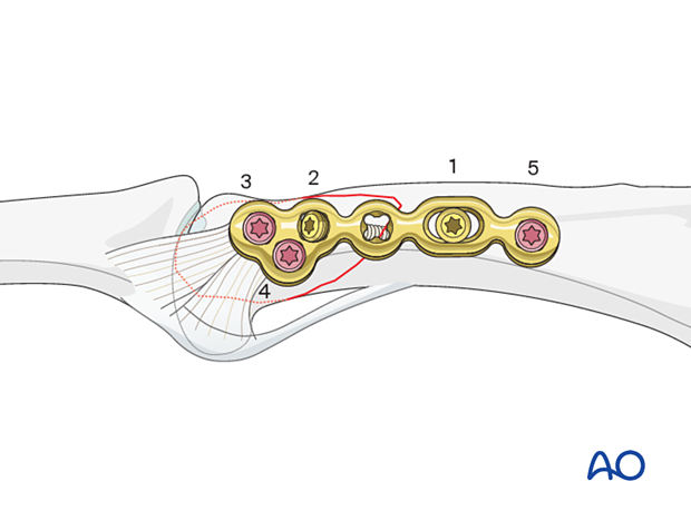 Lag-screw fixation with a neutralization plate of a partial articular fracture of the proximal phalangeal head – order of screw insertion